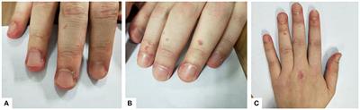 Case Report: Treatment of Anti-MDA5-Positive Amyopathic Dermatomyositis Accompanied by a Rapidly Progressive Interstitial Lung Diseases With Methylprednisolone Pulse Therapy Combined With Cyclosporine A and Hydroxychloroquine